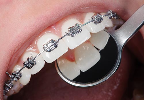 יישור שיניים מרפאת ד"ר מאיר ממריייב - תמונה לדוגמה