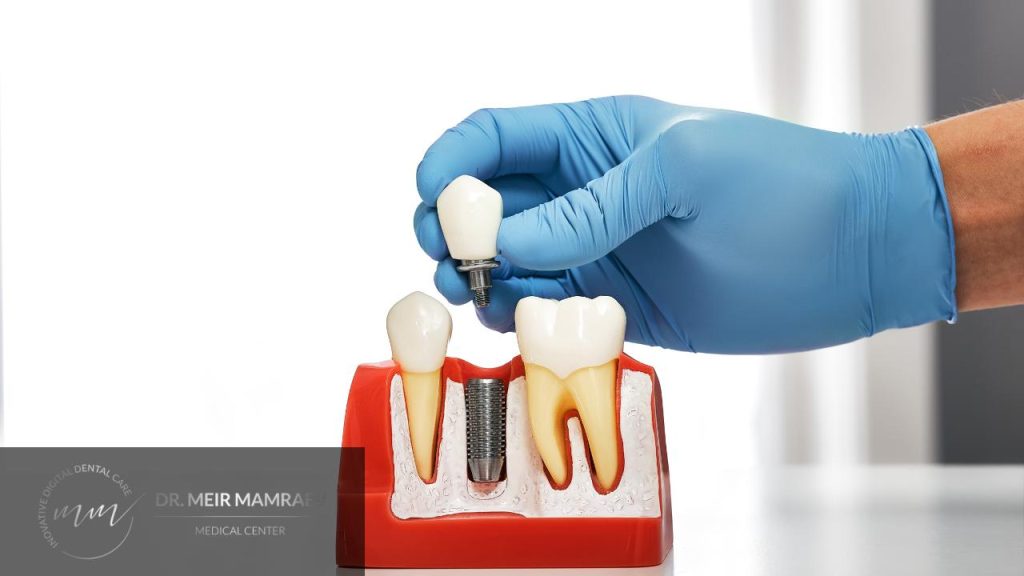 השתלות שיניים ביום אחד - תמונה ראשית - ד״ר מאיר ממרייב