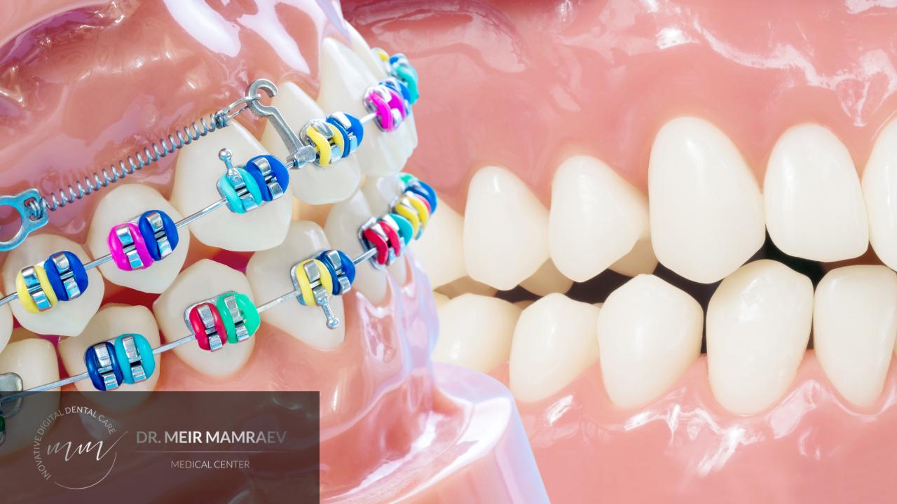 יישור שיניים - תמונה ראשית - ד״ר מאיר ממרייב