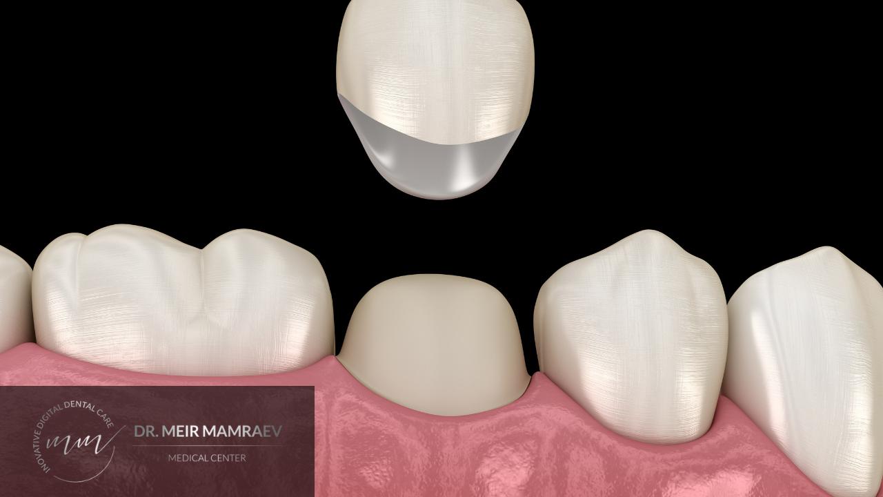 כתרים לשיניים - תמונה ראשית - ד״ר מאיר ממרייב