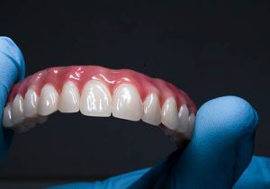 תמונה להמחשה: השתלת שיניים בשיטת אול און פור