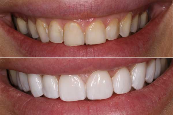 תמונה של מטופל שעבר ציפוי חרסינה לשיניים - לפני ואחרי