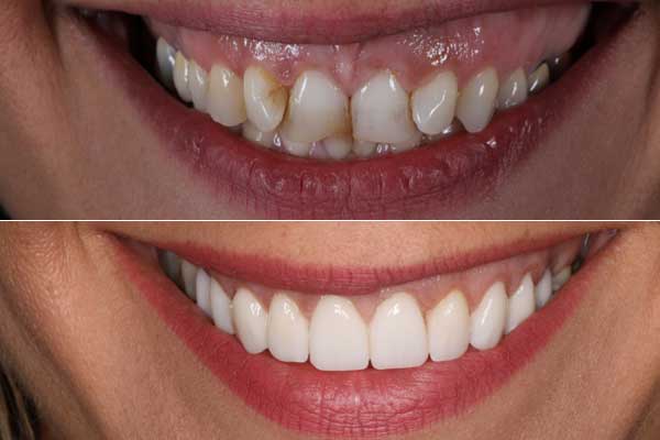 תמונה של מטופלת - לפני ואחרי טיפולי ציפוי חרסינה לשיניים