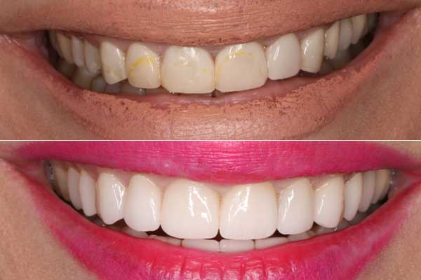 תמונה של מטופלת שעברה ציפויי חרסיה בשיניים - לפני ואחרי