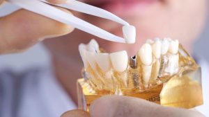 שיטות להשתלת שיניים - תמונה להמחשה