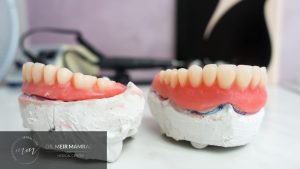 השלמת שיניים - תמונה ראשית - ד״ר מאיר ממרייב