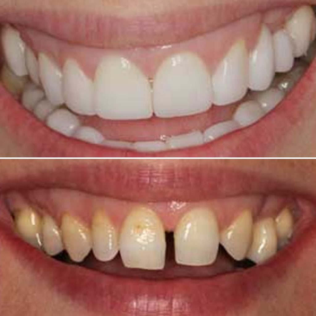 טיפול ציפויים לשיניים עם רווח מטופלת לפני ואחרי