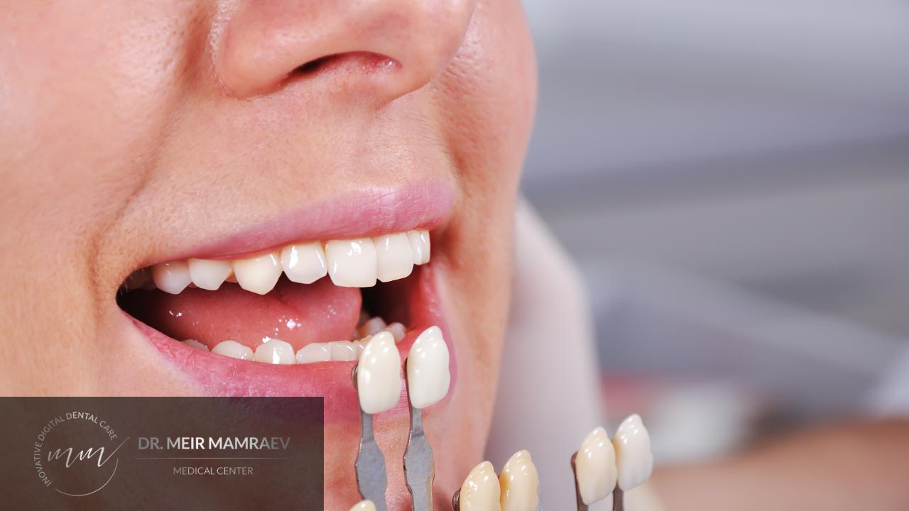 ציפוי שיניים - תמונה ראשית - ד״ר מאיר ממרייב