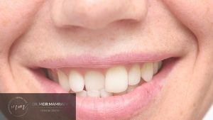 שיניים עקומות - תמונה ראשית - ד״ר מאיר ממרייב