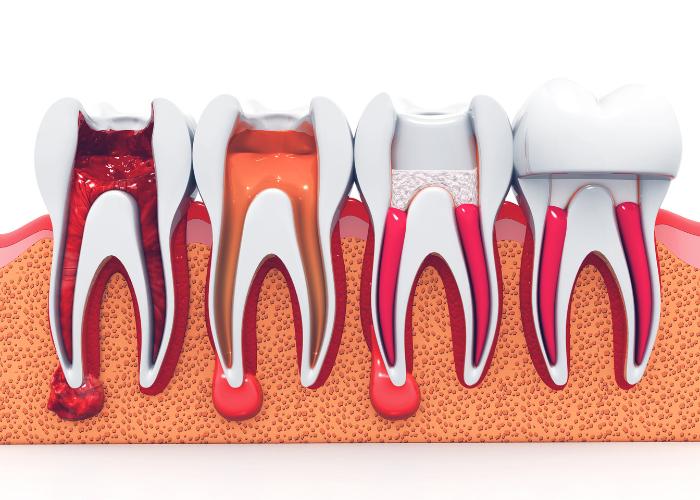טיפול שורש - הדמייה של שיניים במהלך טיפול שורש ד״ר ממרייב