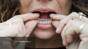 יישור שיניים למבוגרים - ד״ר ממרייב