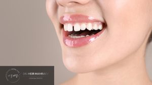 השלמת רווח בשיניים - תמונה ראשית - ד״ר מאיר ממרייב