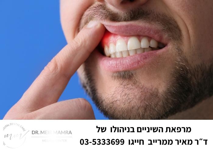 תמונה לדוגמה של נסיגת חניכיים - מרפאת השיניים של ד״ר מאיר ממרייב