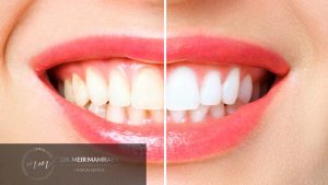 הלבנת שיניים - תמונה ראשית - ד״ר מאיר ממרייב