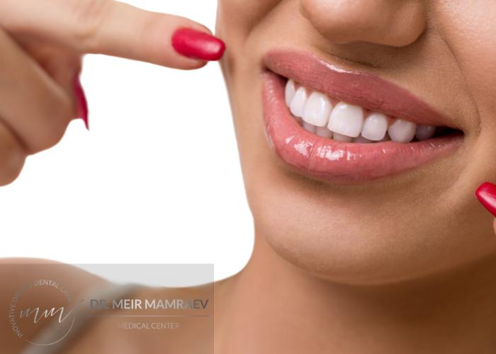 תמונה לדוגמה של חיוך מושלם לאחר יישור שיניים - ד״ר מאיר ממרייב