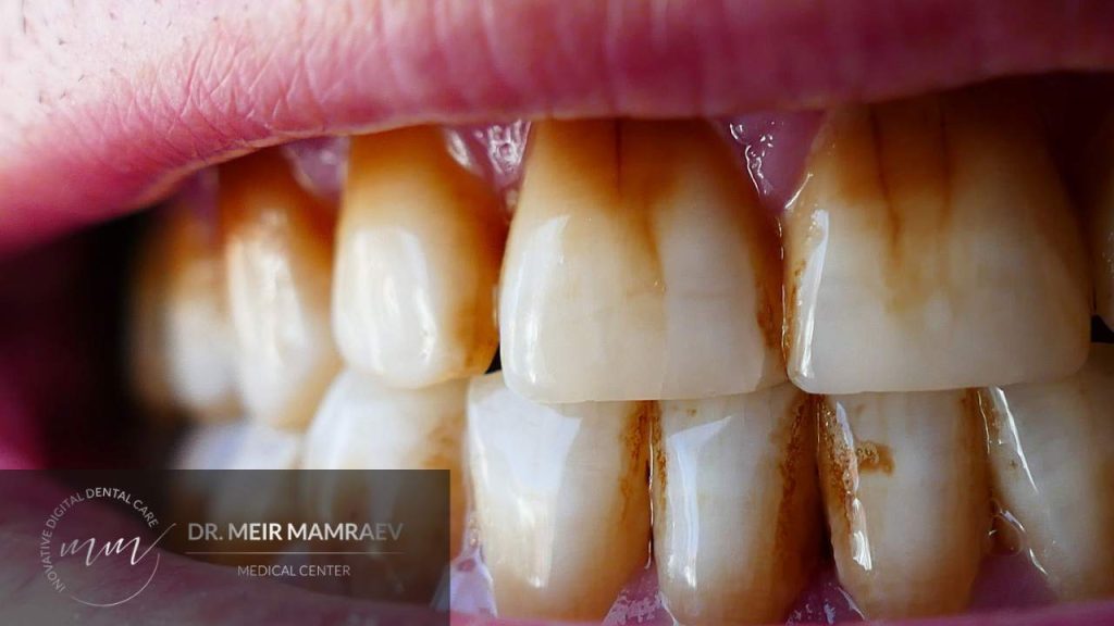 כיצד לטפל ולמנוע כתמי עישון על גבי השיניים תמונה ראשית