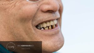 כתמים בשיניים ד״ר מאיר ממרייב - תמונה ראשית