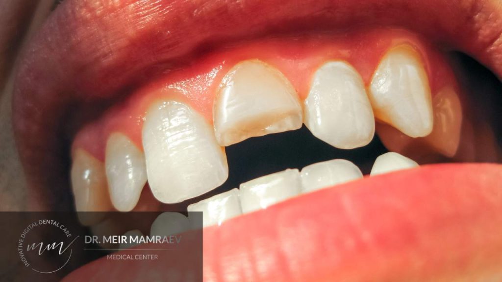 פתרון לשיניים סדוקות או שבורות תמונה ראשית