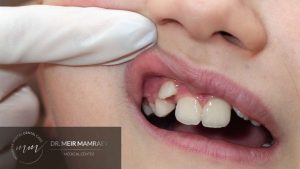 _יישור שיניים לילדים – מתי, מדוע ואיך תמונה ראשית