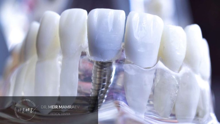 טיפול השתלת שיניים קדמיות - איך זה עובד ד״ר מאיר ממרייב - תמונה ראשית