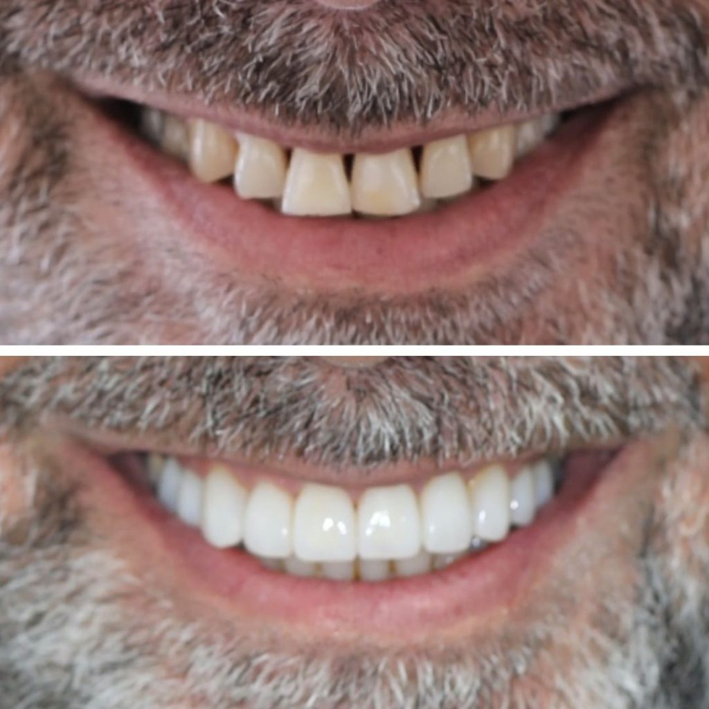 הפיכת חיוך: שינוי גלוי עם שיניים ישרות ולבנות יותר