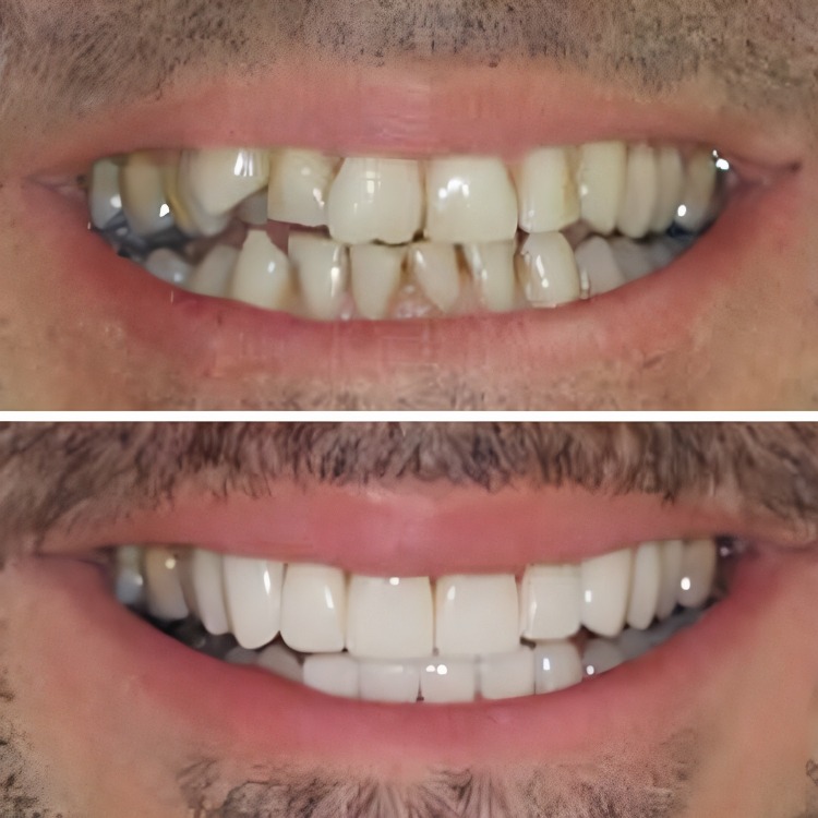 שינוי בחיוך לאחר התקנת ציפויים על שיניים קדמיות - תמונה לפני ואחרי