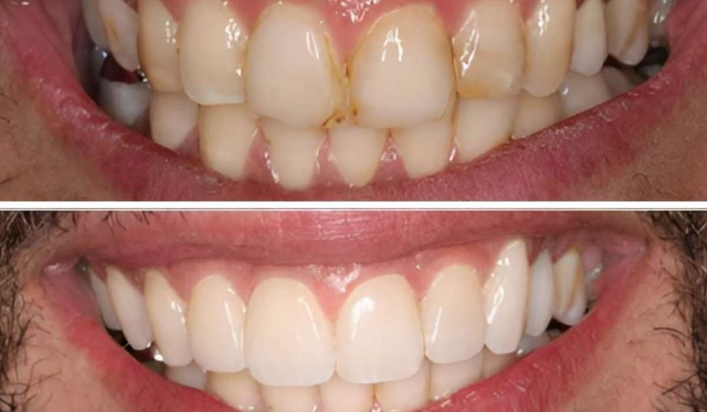 שיקום פה פגמים בשיניים לפני ואחרי מטופל