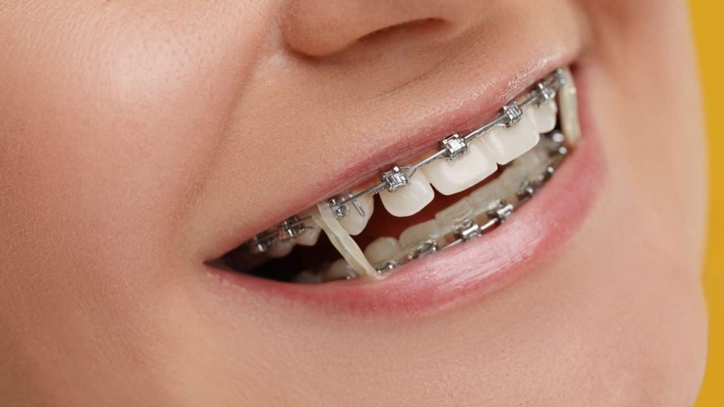 גשר בשיניים עם גומיות תמונה ראשית דר מאיר ממרייב