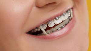 גשר בשיניים עם גומיות תמונה ראשית דר מאיר ממרייב