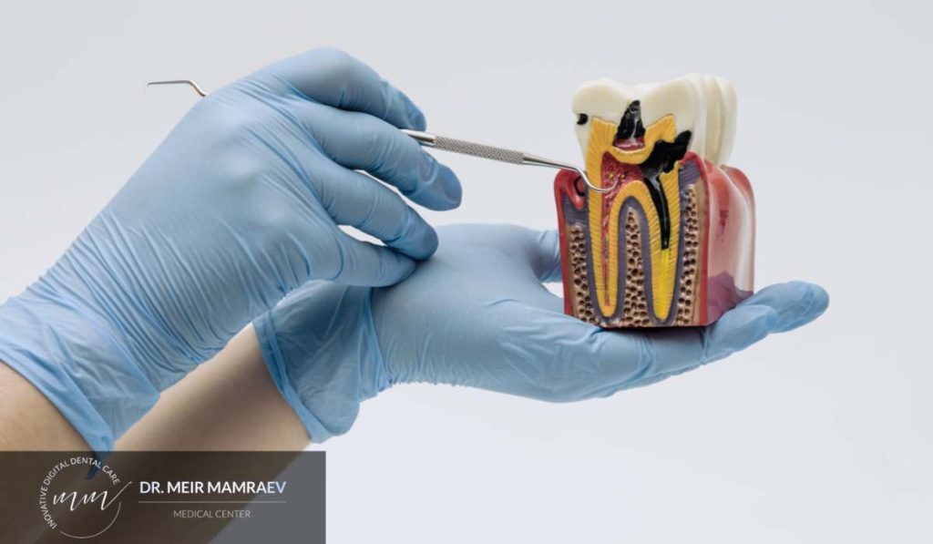 האם כדאי לבצע השתלת עצם כבר בזמן העקירה, או שאפשר לחכות