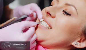 מתי בכלל עושים ציפוי לשן בודדת